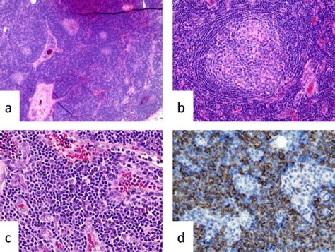 Pathological Findings Of The Cervical Lymph Node Biopsy A Lymph Node Download Scientific