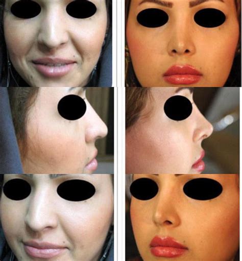 Iranian Nose Operation Before And After 2 Rhinoplasty Cost Pics