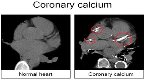 Cardiovascular Disease Uncovered Coronary Calcium Scan Regenerative