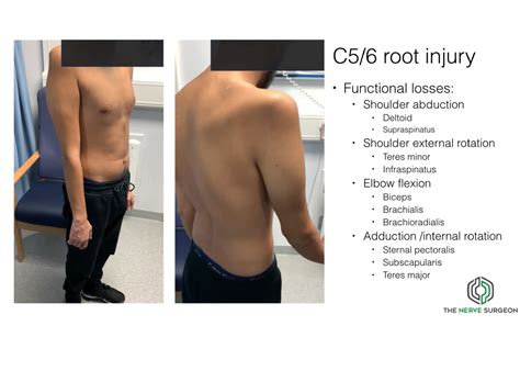 Brachial Plexus Injuries NBKomputer