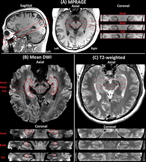 Highresolution Diffusion Tensor Imaging And T2 Mapping Detect Regional