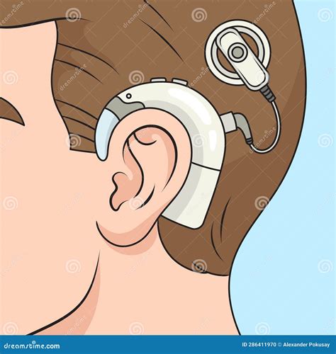 Diagramma Di Impianto Cocleare Illustrazione Di Stock Illustrazione