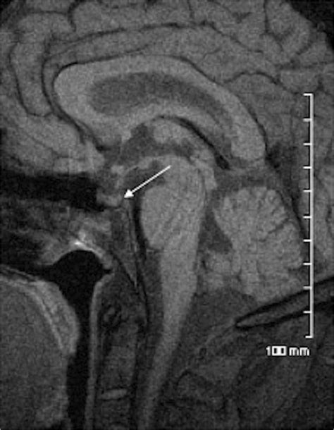 Sagittal T1 Postcontrast Mri Of The Sella A Demonstrates Absence Of