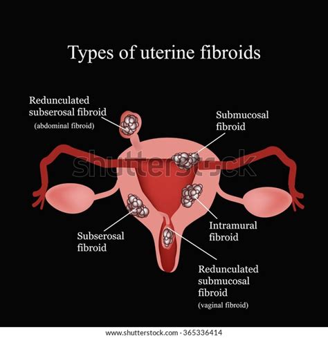 Types Uterine Fibroids Endometriosis Infographics Vector Stock Vector