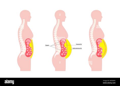 Visceral Fat Diagram Illustration Belly Fat Surrounds Internal Organs In Abdominal Cavity