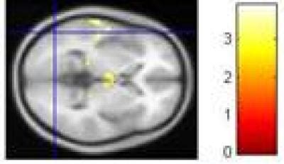 Abnormal Activation Of The Occipital Lobes In EurekAlert