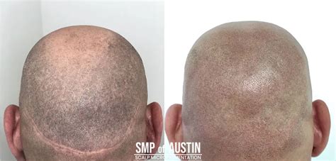 What Is Scalp Micropigmentation Top 3 Benefits Of Scalp