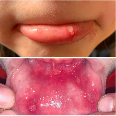 Figure 2 From Recurrent Aphthous Stomatitis Semantic Scholar