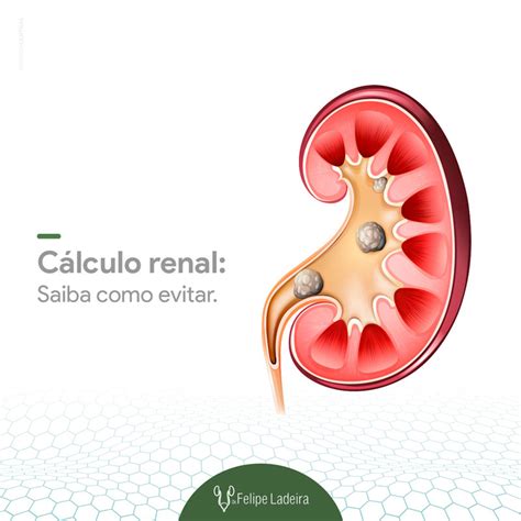 C Lculo Renal Saiba Como Evitar Dr Felipe Ladeira