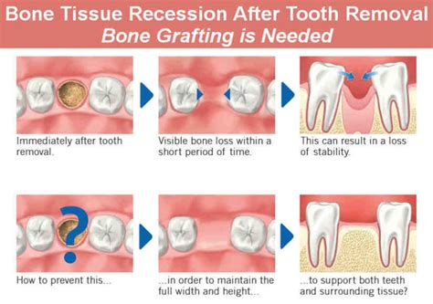 How Much Does It Cost For Bone Grafting For Dental Implants Dental