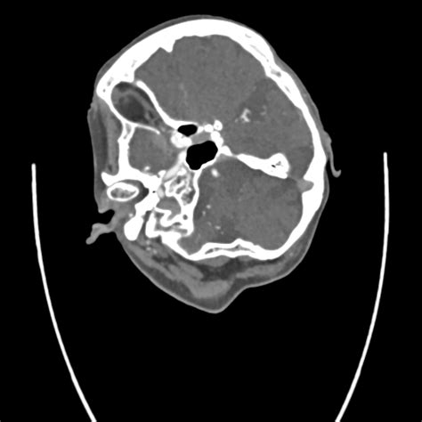 Fileacute Right Mca Infarct Meningioma And Retinal Detachment Ct