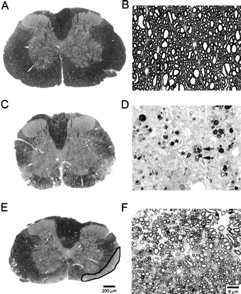 Demyelination And Remyelination Are Observed In The Spinal Cord White