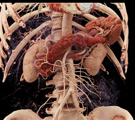 Incidental Pancreatic Neuroendocrine Tumor Pnet In Body Of The