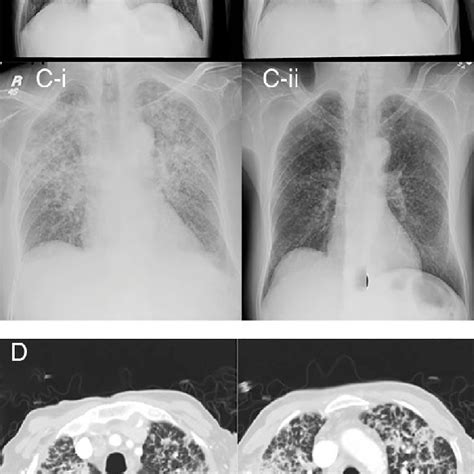 Chest Radiographs On The First A Second B And Third Admissions