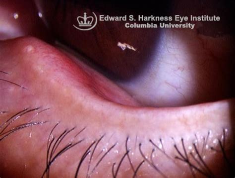 External Hordeolum | Vagelos College of Physicians and Surgeons