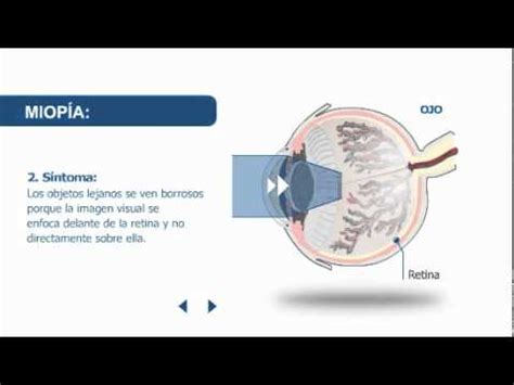 Todo Lo Que Necesitas Saber Sobre La Miop A Causas S Ntomas Y