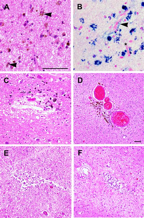 Ex Vivo Mri Facilitates Localization Of Cerebral Microbleeds Of