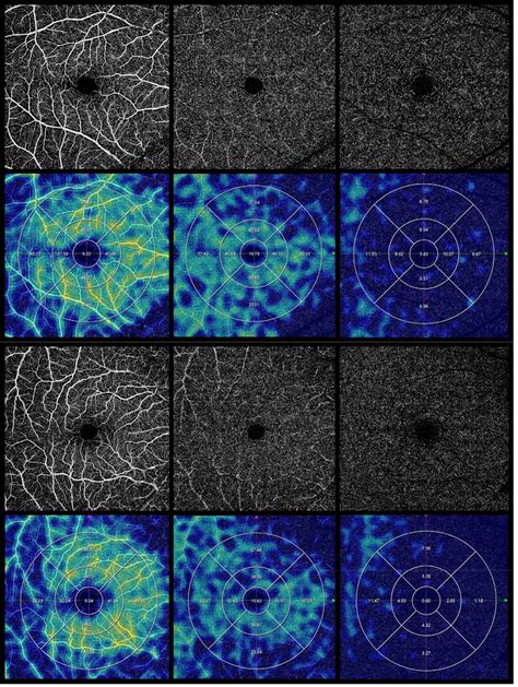 Representative Ss Octa Mm Image Of Vessel Density Of Superficial