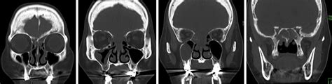 Acute Invasive Fungal Sinusitis Radiology Cases