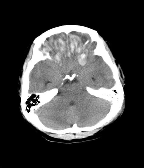 Bifrontal Cerebral Contusions Radiology Case Brain Images Mri Neurology