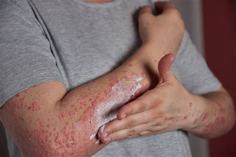 Psoriasis Symptoms Causes Types And Treatment Health Tips