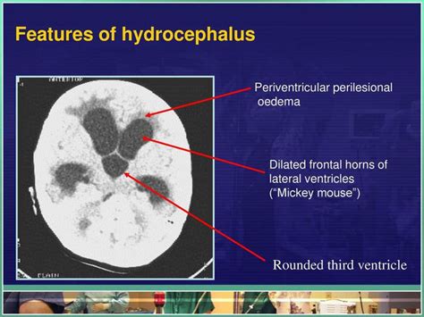 CT Findings Of Hydrocephalus MEDizzy