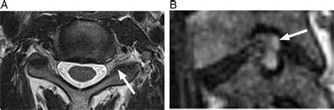 Comparison Of Mri Grading For Cervical Neural Foraminal Stenosis Based