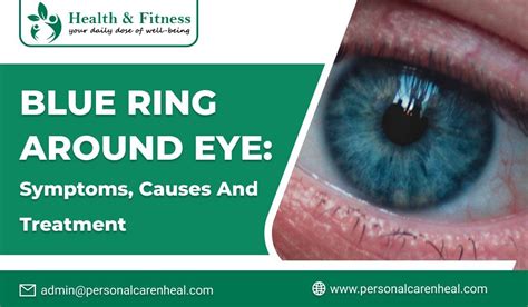 Blue Ring Around Eye Causes Symptoms And Treatment