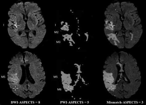 Aspects Alberta Stroke Program Early Ct Score Assessment Of The