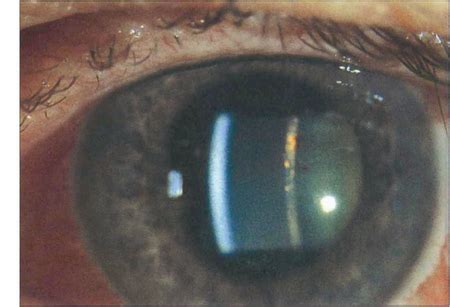 Intraocular Inflammation Ento Key