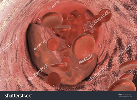 Atheroma Plaque Inside Artery 3d Illustration Stock Illustration