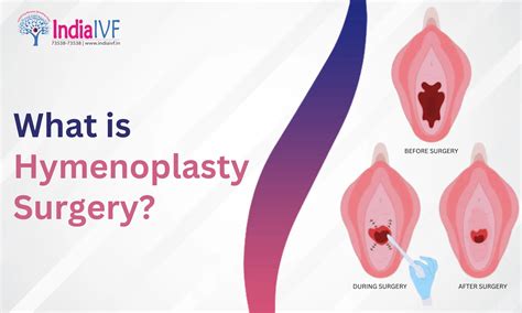 What Is Hymenoplasty Surgery Everything You Need To Know