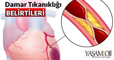 Damar T Kan Kl Sebepleri Belirtileri Tedavisi Nelerdir Yasamloji