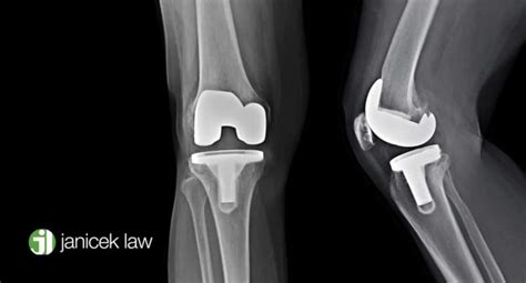 Exactech Knee Recall San Antonio Defective Medical Devices