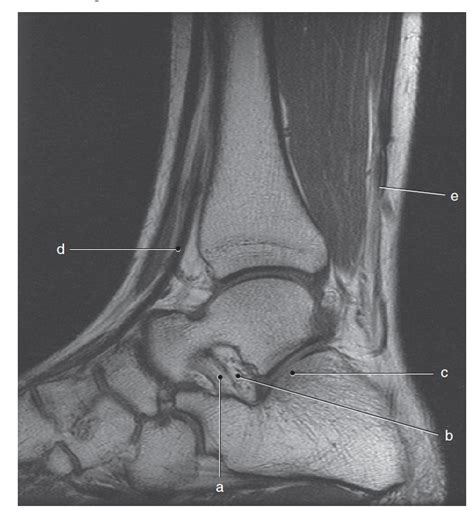 Diagram Of Sagittal Mri Of Calcaneus Quizlet