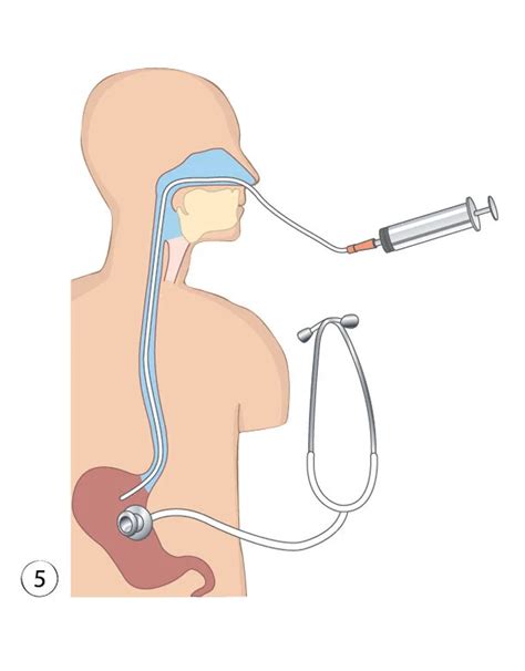 Enterale Ern Hrung Sonden Richtig Legen Und Pflegen