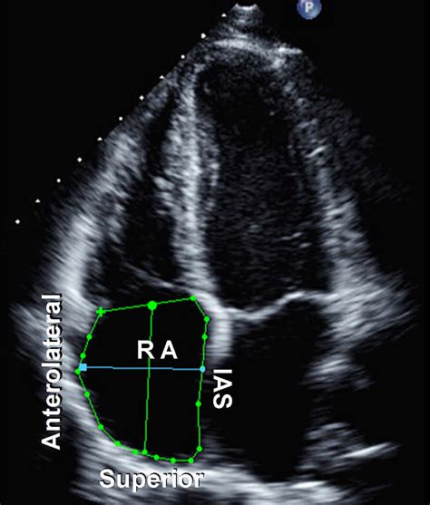 Guidelines For The Echocardiographic Assessment Of The Right Heart In