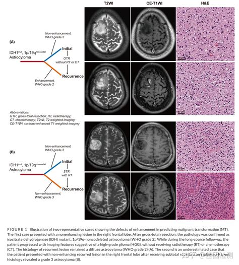 弥漫性低级别胶质瘤不同恶性转化模式的特征及临床意义 知乎