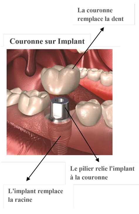 COMPRENDRE LE COuT DES IMPLANTS DENTAIRES Maxillo3d