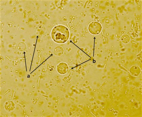 Vacuolar A And Granulat B Cells Of Blastocystis Showing Extensive