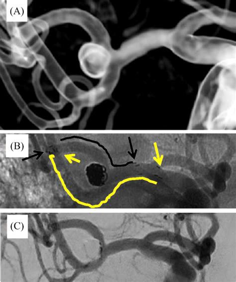 Y‐stent Assisted Coiling Of Wide‐necked Intracranial Aneurysms With The