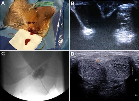 Percutaneous Embolization By Direct Puncture And Outcomes A