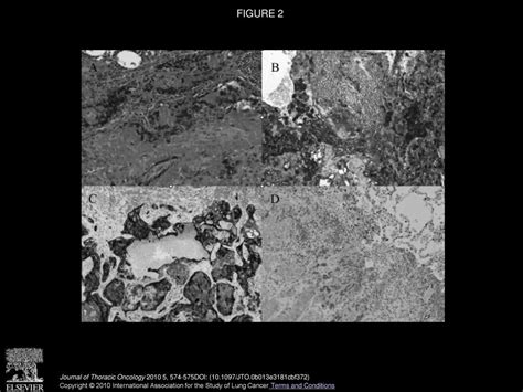 Solitary Choriocarcinoma In The Lung Ppt Download