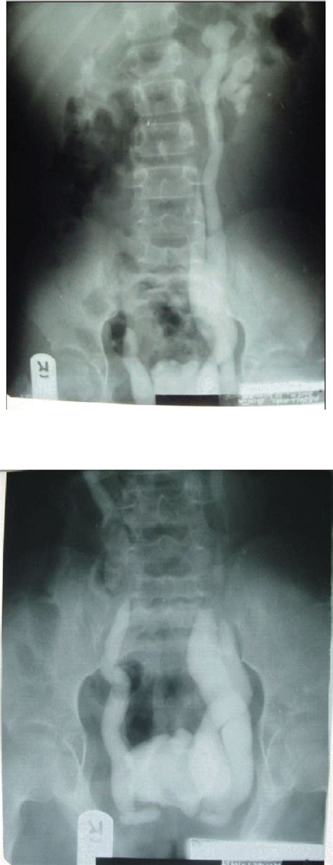 Figure 3 From Imaging Of The Complicated Bladder Exstrophy Presenting With Ureteric Duplication