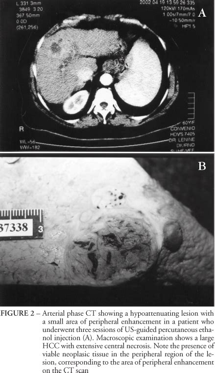 Scielo Brasil Hepatocellular Carcinoma In Patients Undergoing