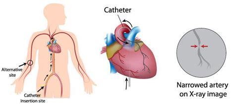 What Is Cardiac Catheterization? - Houston, TX & Cypress, TX: Heart ...