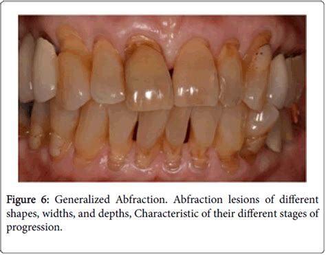 Dentistry Generalized Abfraction