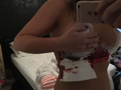 I Spent K On Love Island Boob Job After Shedding St But Nothing Could Have Prepared Me For