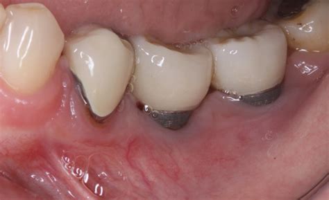 Peri Implantitis Gum Disease Around Implants Treatment Specialist