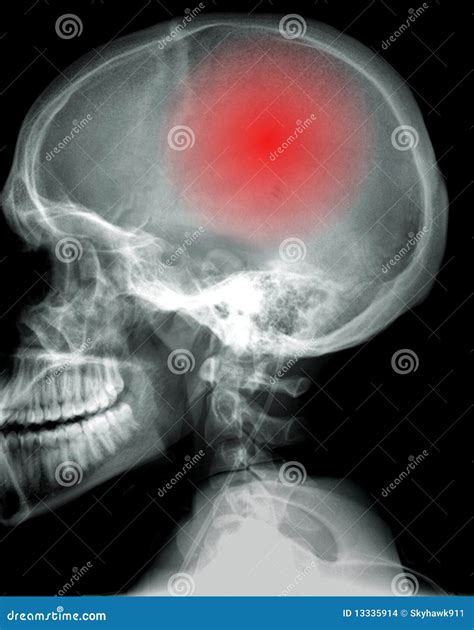 Headcache Skull With Pain Inside Stock Photo Image Of Joint